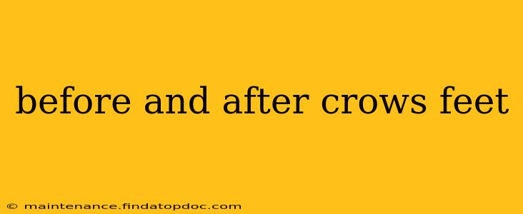 before and after crows feet
