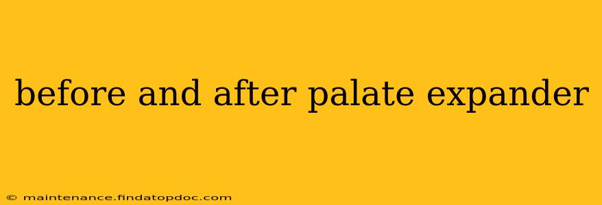 before and after palate expander