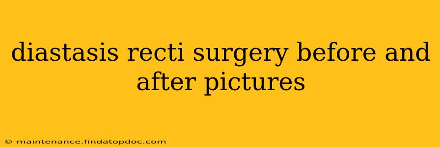 diastasis recti surgery before and after pictures