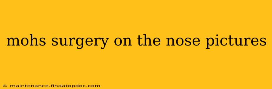 mohs surgery on the nose pictures