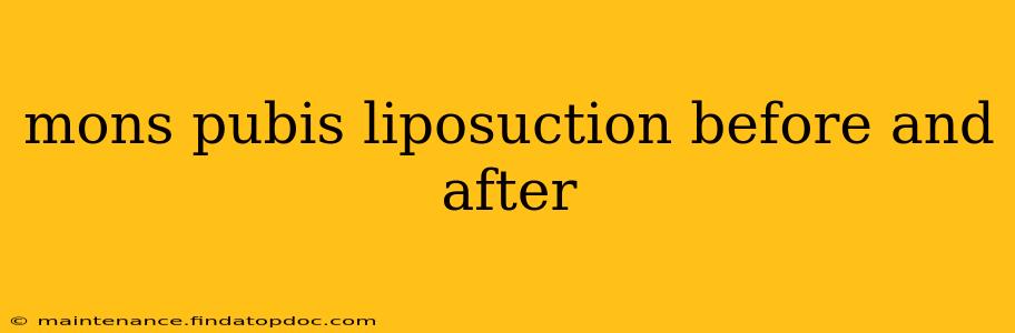 mons pubis liposuction before and after