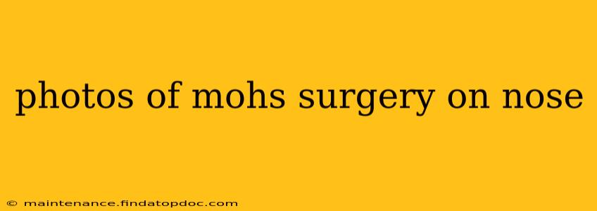 photos of mohs surgery on nose