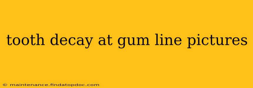 tooth decay at gum line pictures