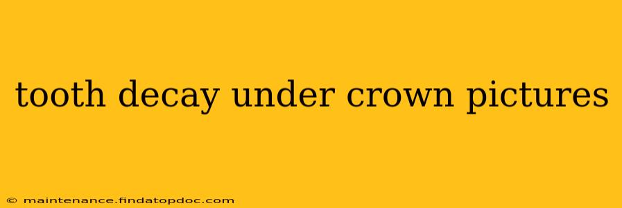tooth decay under crown pictures